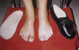 Plantillas para Pie Diab�tico confeccionadas en plastazote, previo modelaje en escayola.