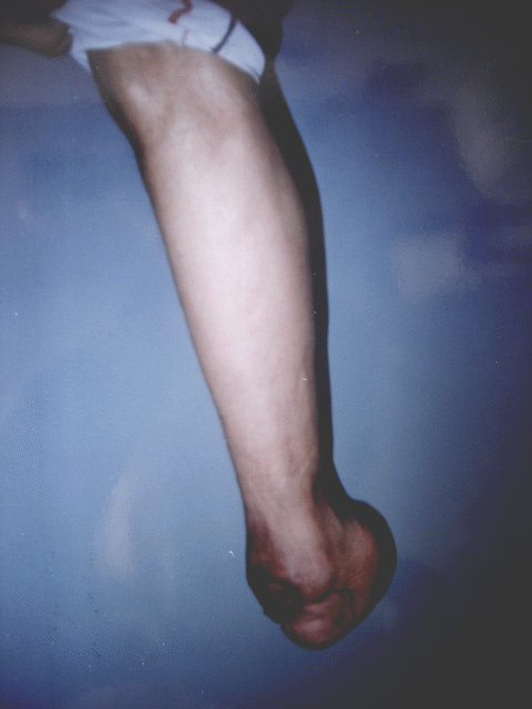 Paciente amputado subtotal del pie izquierdo (Chopart) mostrando las caracter�sticas del mu�on de amputaci�n.