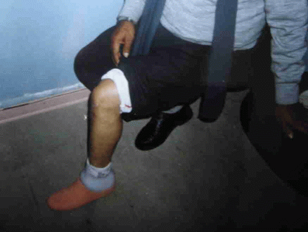 Paciente con amputaci�n Chopart (mediotarsiana) con adaptaci�n ortoprot�sica.