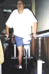 Paciente portadora de amputaci�n transfemoral disvascular en entrenamiento con pr�tesis temporaria graduable.