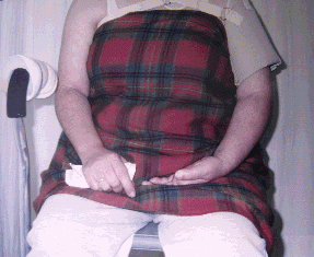 Paciente con hemiparesia izquierda post EVC.  Adaptaci�n de estabilizador postural del hombro (modificado)