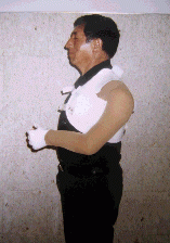 Pre-protesis confeccionada en termopl�stico - Terapia Ocupacional - HNGAI (vista lateral)