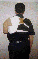 Pre-pr�tesis para amputaci�n IET confeccionada en nuestra Unidad de Amputados (vista posterior)