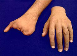 Amputación parcial de mano equipada con guante cosmético con relleno.