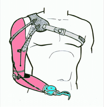 Prótesis trashumeral (AE) Cheststrap harness- Vista anterior. 